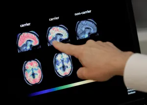 9 in 10 adults with Down syndrome develop Alzheimer’s. UNT Health research is exploring why